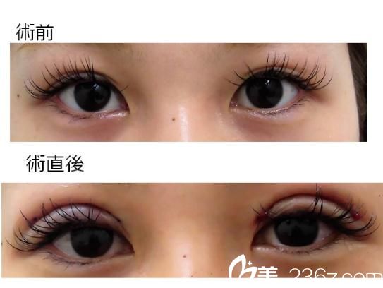 揭秘最新双眼皮法，现代眼部美容新趋势解析